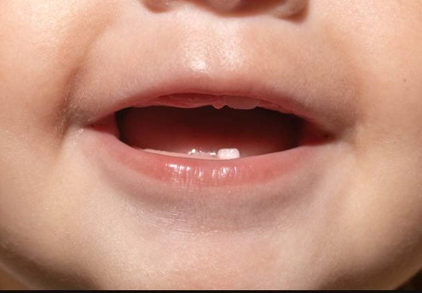 Photo of a babies teeth first coming in