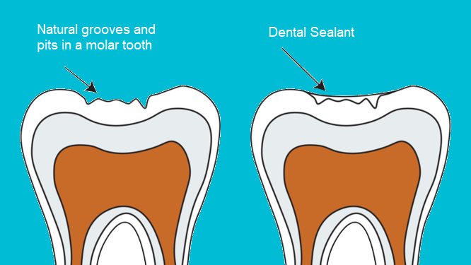 dental sealant coating natural grooves and pits in molar tooth