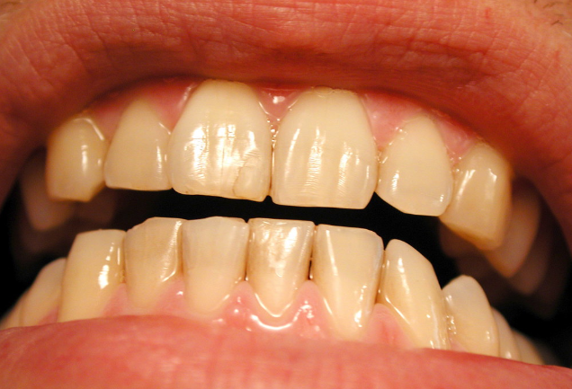 Photo of Yellow Teeth