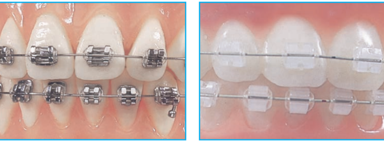 Traditional metal braces in Tempe and Avondale Arizona